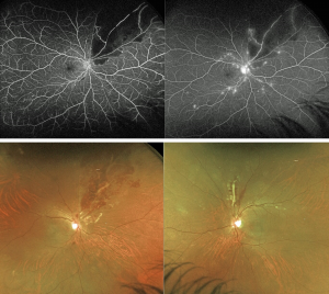 Lupus retinopathy