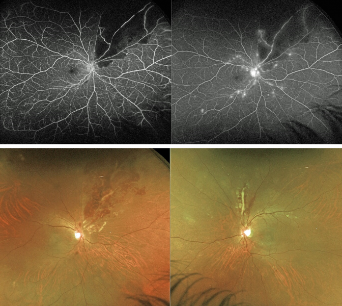 File:Lupus retinopathy.png