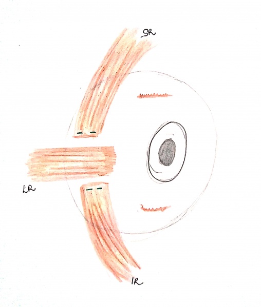 File:Full tendon transposition.jpg