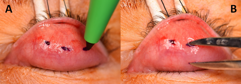 File:MMCR Eyewiki Figure 3.png