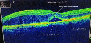 OCT image 2 showing retinal pigment epithelial aperture at the top PED