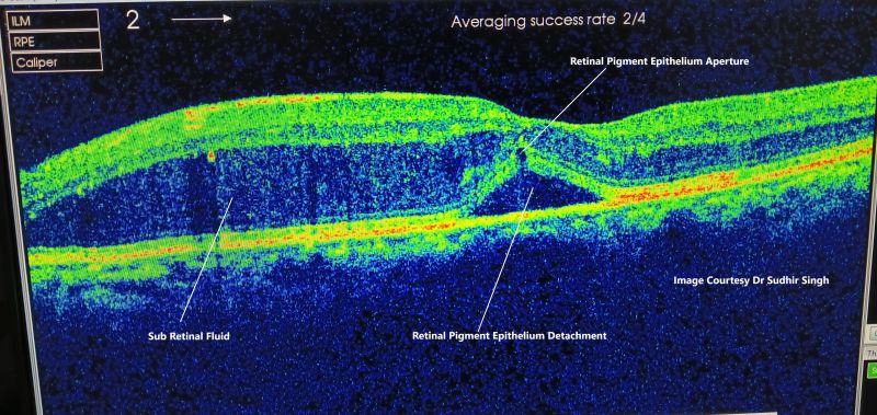 File:Pigment Epithelial Detachment with Aperture.jpg