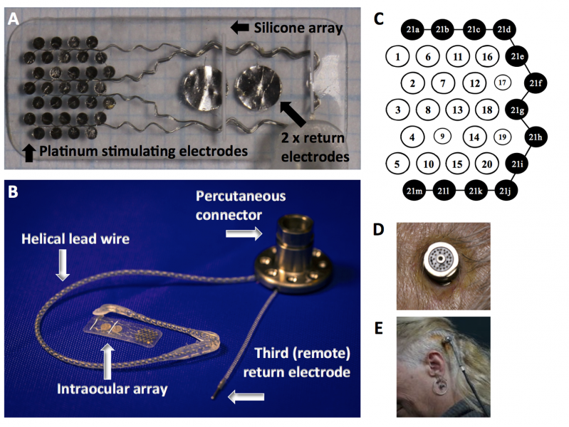 File:Suprachoroidal prosthesis fig2.png