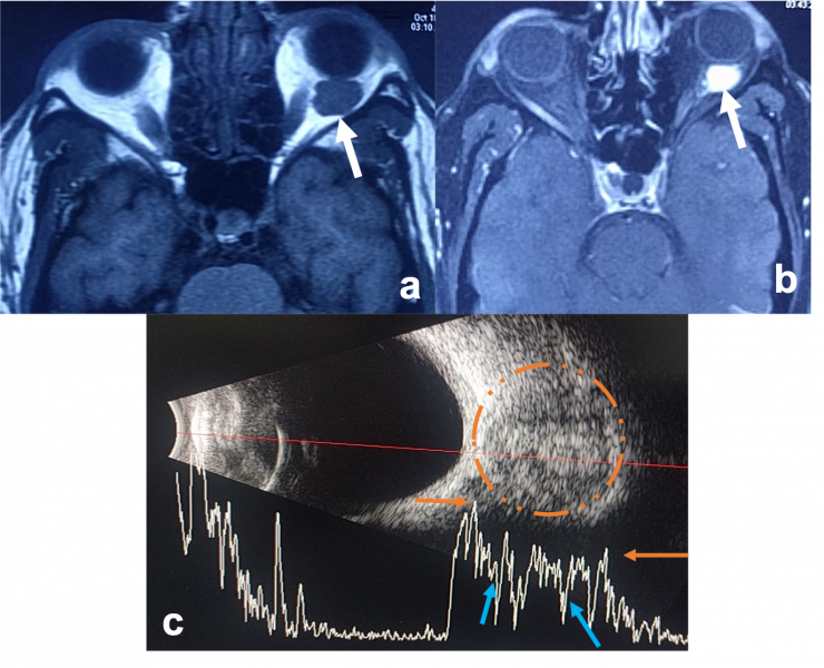 File:Cavernous hemangioma.png