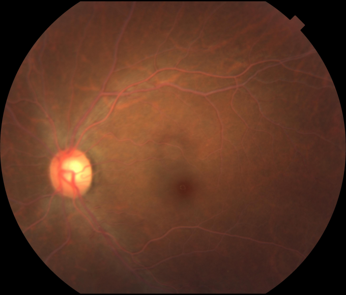 File:Lipemia retinalis OS.png