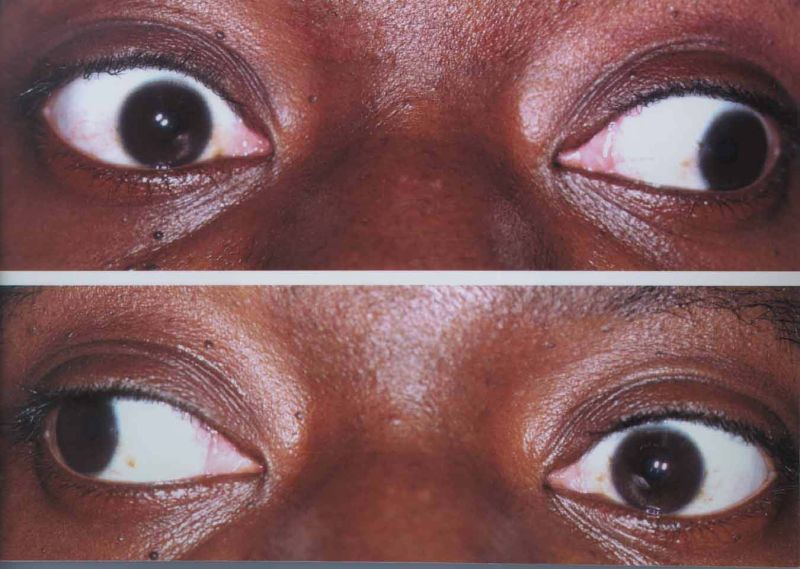 File:Myasthenia Gravis.jpg