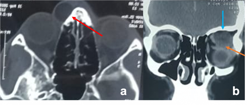 File:Dermoid cyst.png