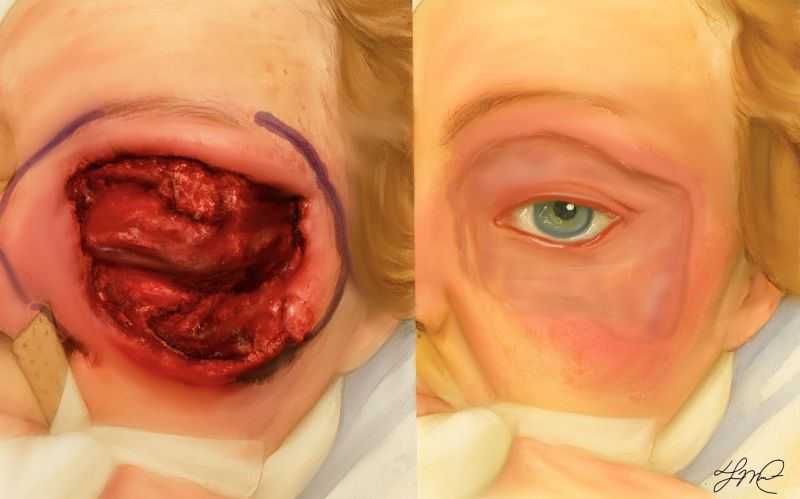 File:Sweet Syndrome .jpg