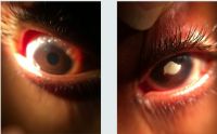 8-year-old boy with limbal vernal keratoconjunctivitis (OU) and shield ulcer plaque (OS) on slit-lamp examination