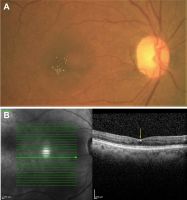 West African Crystalline Maculopathy in a Nigerian Woman