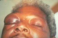 Blunt trauma with orbital and eyelid edema