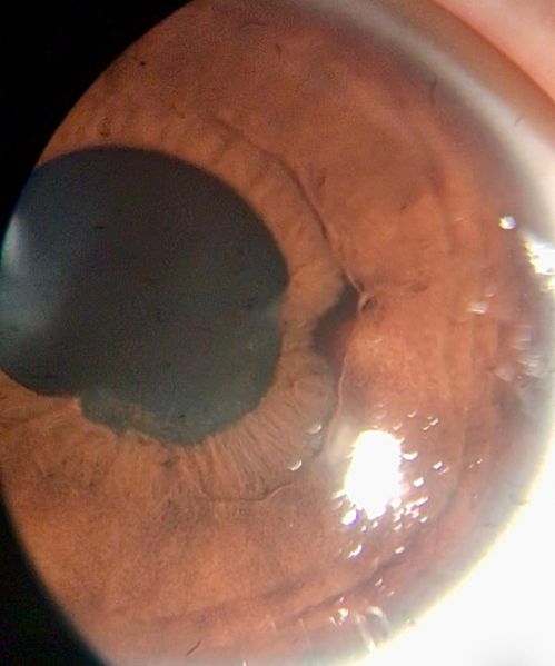 File:Localised iris bulge.jpeg