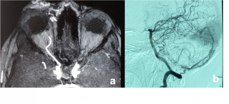 File:Arterio venous malformation.png