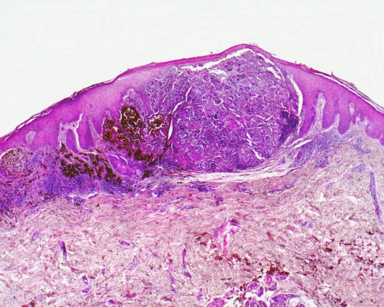 File:Cutaneous Nodular Melanoma.jpg