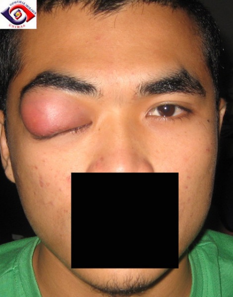File:Dacryoadenitis1.jpg