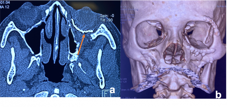 File:Post fracture repair.png
