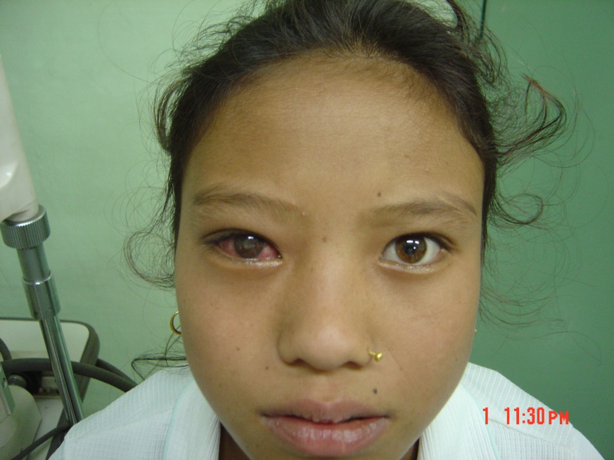 SHAPU - Seasonal Hyperacute Pan-Uveitis - EyeWiki