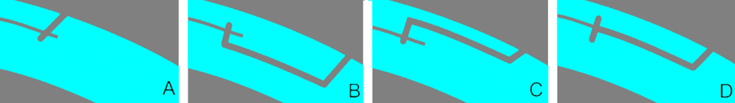 CIRCLE software - various types of cuts A) Direct cut, no lamellar ring B) Deep lamellar ring C) Shallow Lamellar ring D) Equal depth lamellar ring