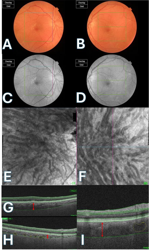 (A, B) Color fundus photographs of the right and left eyes, respectively. Note the presence of subtle macular pigmentary changes. (C, D) Red-free images of the right and left eyes, respectively. These images enhance the visibility of retinal vasculature and subtle retinal changes. (E, F) En-face OCT images at the choroid level show dilated choroidal vessels (Pachyvessels). (G) Enhanced Depth Imaging Optical Coherence Tomography (EDI-OCT) of the right eye demonstrated increased choroidal thickness (red arrow), particularly in the superior part of the macula. (H) EDI-OCT of the right eye with binarization highlighting large choroidal vessels (Pachyvessels outlined in yellow). The red arrow shows the choroidal thickness measurement in the inferior macula. (I) EDI-OCT of the left eye showing a thickened choroid (red arrow), and dilated choroidal vessels (Pachyvessels outlined in yellow). Overall, the left eye exhibits more prominent pachyvessels and a generally thicker choroid compared to the right eye. (Image courtesy of J. Khadamy)
