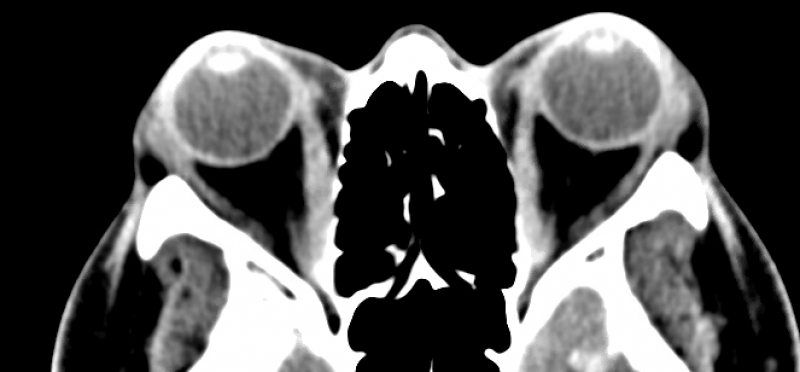 File:CTExophthalmos.png