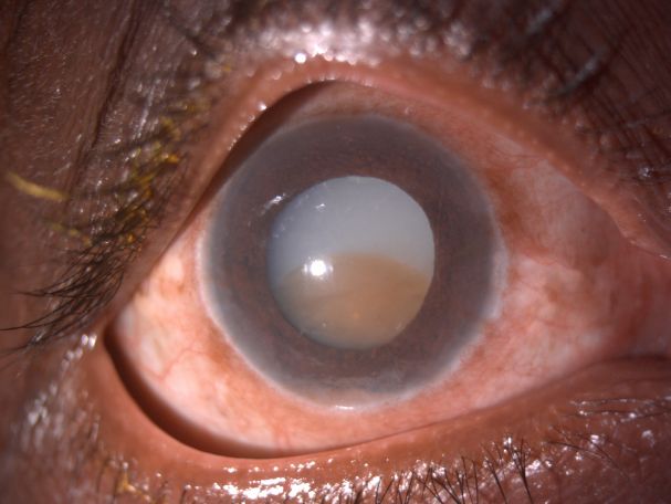 Figure 2: Morgagnian cataract with sunken nucleus in a liquid cortex