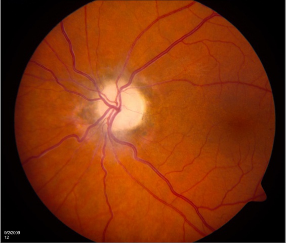 Optic atrophy.jpg