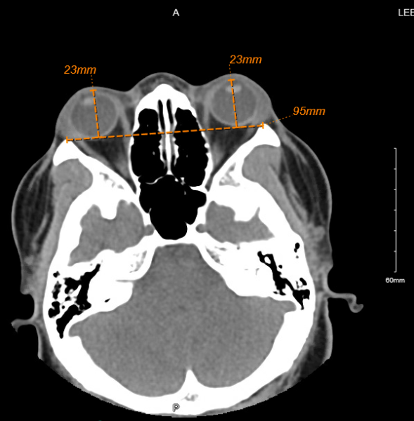 File:Radiological Exophthalmometry.png