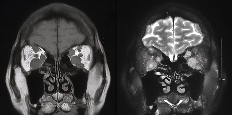 File:MRI EOM Mets.png