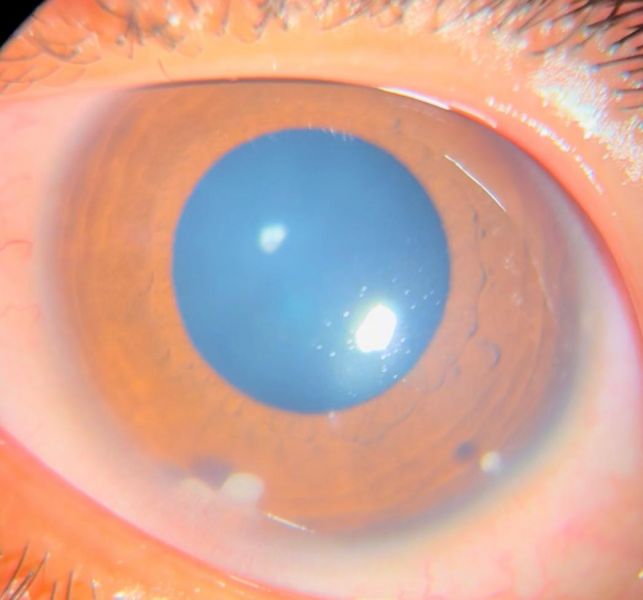 File:Classic inferior AC nodules.jpeg