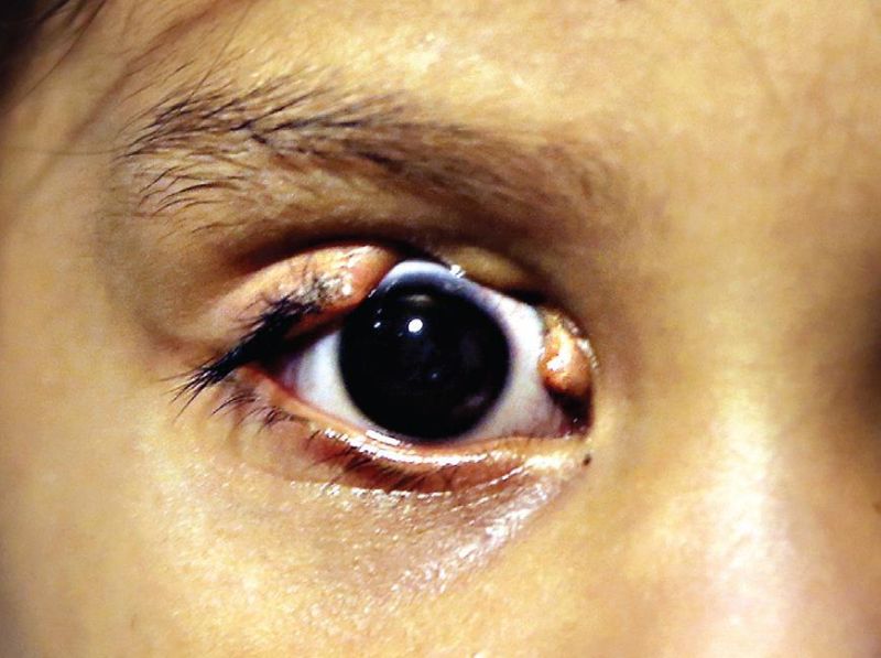 File:Congential glaucoma.jpg