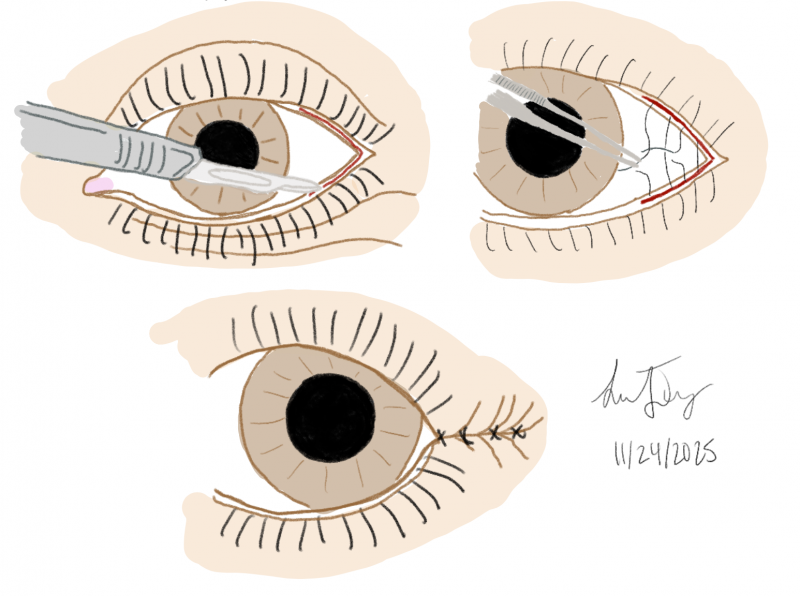 File:Permanent Tarsorrhaphy.png