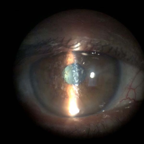 File:Granular Dystrophy (2).JPG.jpg