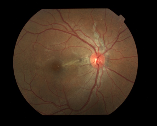 AngioidStreak OD color photo.jpg