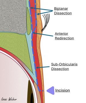 Image depicting dissection path for FM advancement procedure