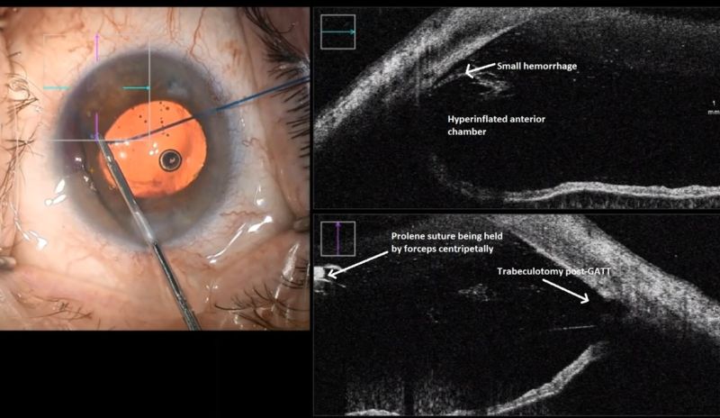 File:Fig.12 intraop oct.jpg