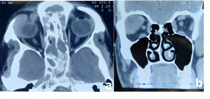 File:Psuedotumor of Lacrimal Gland.png