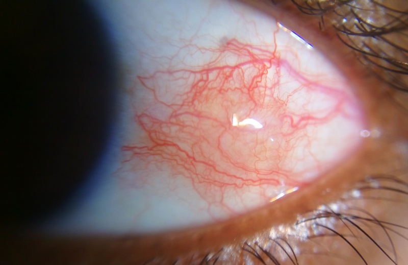 File:Episcleritis2.jpg
