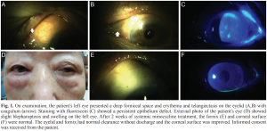 Giant fornix syndrome