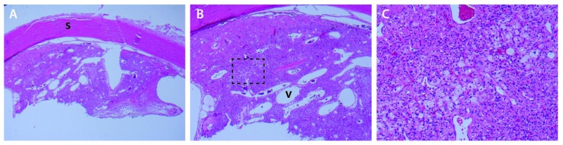 File:VHL Pathology2.jpg