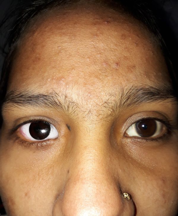 Contracted Socket - EyeWiki