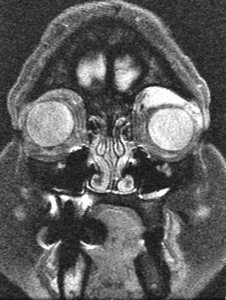 File:Orbital plasmacytoma MRI 2.JPG