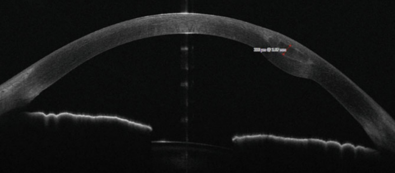 File:Anterior Segment OCT Jacob.png