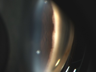 Combined Mechanism Glaucoma With Scattered PAS