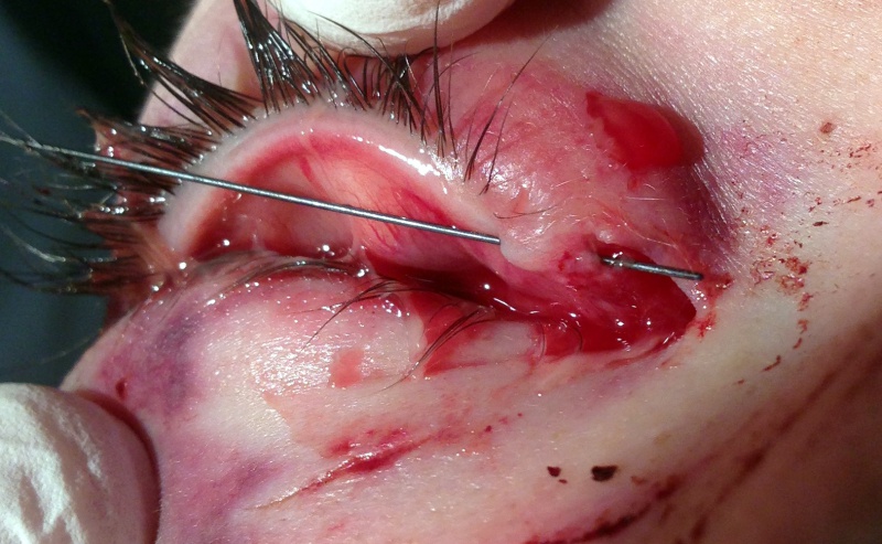 File:Cropped RUL Bowman Probe Canaliculus.jpg
