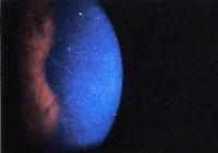 Course epithelial keratopathy with roughed epithelial and fine filaments. Patient was subsequently lost to follow-up and presented 3 months later with large shield ulcer and plaque.