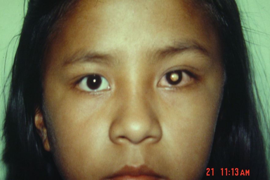 SHAPU - Seasonal Hyperacute Pan-Uveitis - EyeWiki