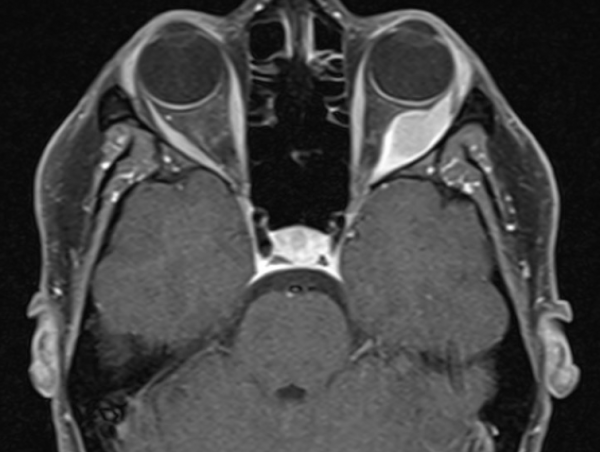 Orbital Granular Cell Tumor - EyeWiki
