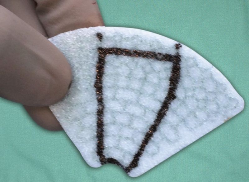 File:Orbital implant 9.jpg
