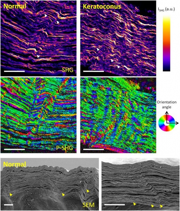 Vogt’s Striae - EyeWiki