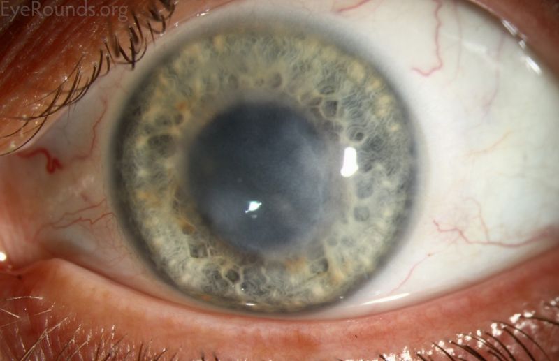 File:VZV disciform keratitis.jpg
